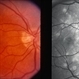 multifocal choroiditis